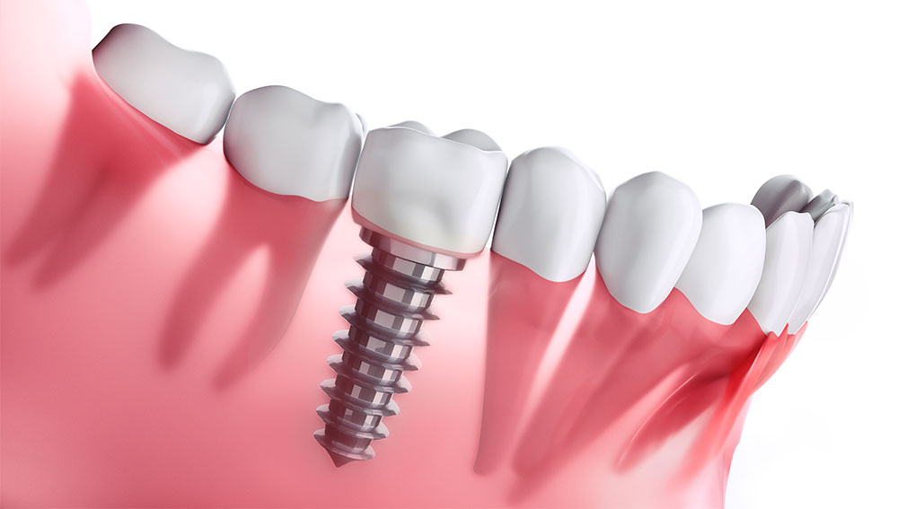 Implantate - Zahnarztpraxis Dr. Gerhaupt in 45259 Essen-Heisingen