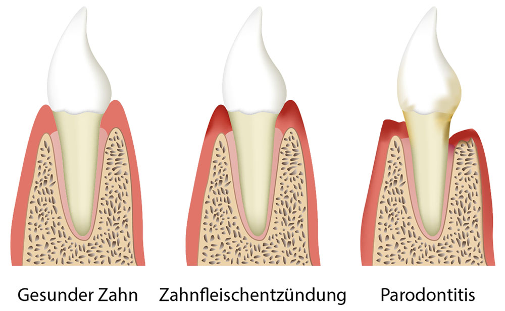 Parodontitis / Parodontose - Zahnarztpraxis Dr. Gerhaupt in 45259 Essen-Heisingen